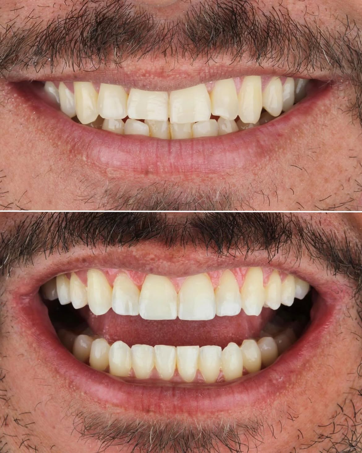 Resultado real de paciente, antes e depois, GS Odontologia