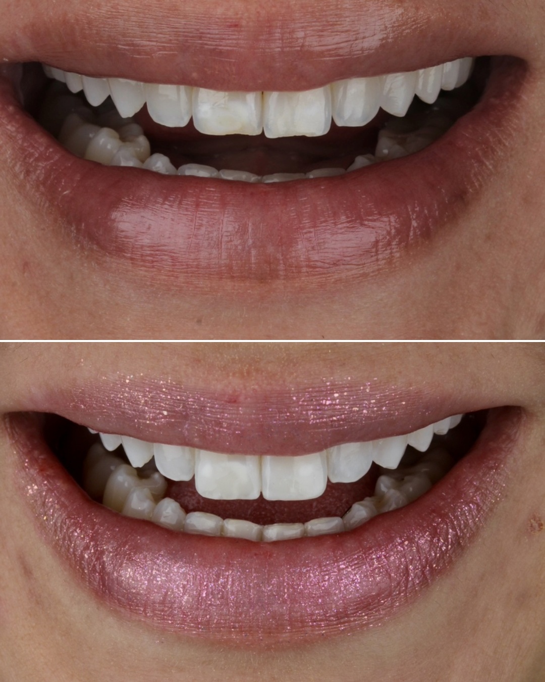 Resultado real de paciente, antes e depois, GS Odontologia