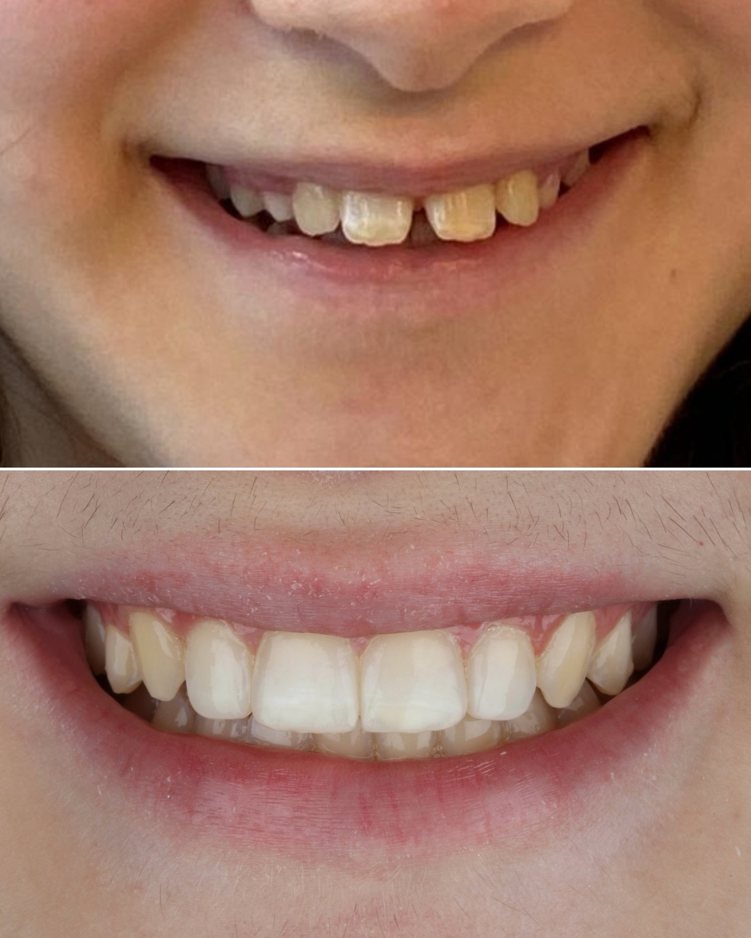 Resultado real de paciente, antes e depois, GS Odontologia